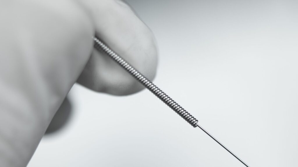 Dry Needling - Sunshine Coast Heel Pain Clinic